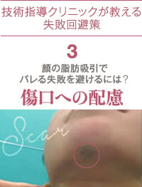 顔の脂肪吸引の失敗回避策3:傷口を目立たせない