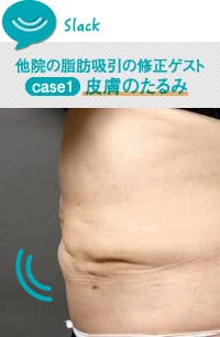 脂肪吸引でよくある後遺症「皮膚のたるみ」