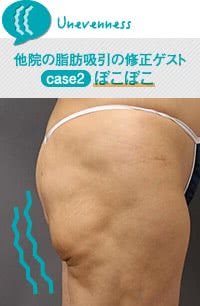 脂肪吸引でよくある後遺症「ぼこぼこ」
