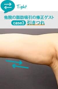 脂肪吸引でよくある後遺症「引きつれ」