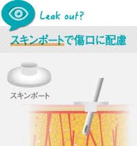脂肪吸引による火傷を防ぐスキンポート