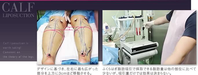 ふくらはぎの脂肪吸引でTHE CLINIC が手術前に施す「長く見せる」デザイン