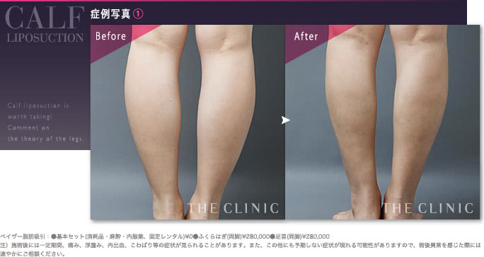 35歳女性のふくらはぎのベイザー脂肪吸引の症例（皮下脂肪が多いタイプ）