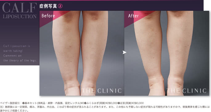 45歳女性のふくらはぎのベイザー脂肪吸引の症例（皮下脂肪が多いタイプ）