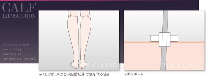 ふくらはぎの脂肪吸引でできる傷と皮膚に傷を残さない工夫（スキンポート）
