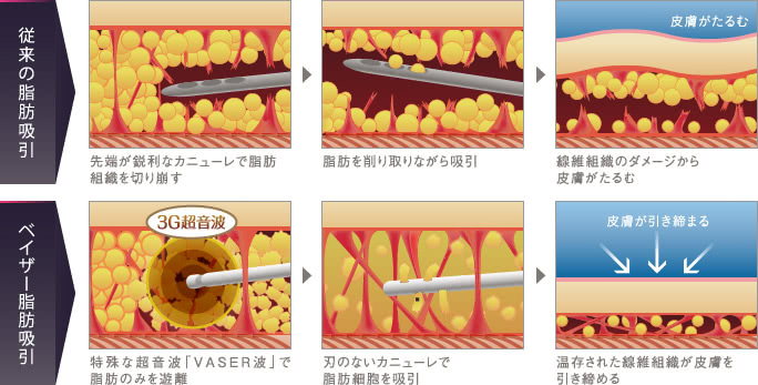 従来の脂肪吸引とベイザー脂肪吸引のダウンタイムの違い