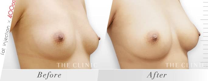 THE CLINIC の脂肪注入豊胸で片胸400㏄、両胸800㏄注入した症例