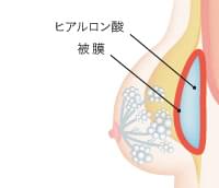 画像:ヒアルロン酸豊胸での生体反応