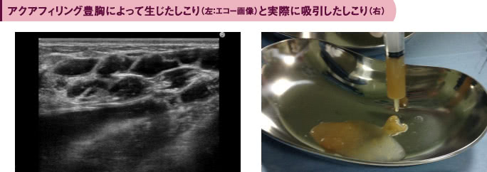 アクアフィリング豊胸のしこり（エコー画像と除去画像）