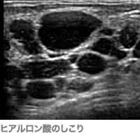 ヒアルロン酸豊胸のしこりのエコー画像