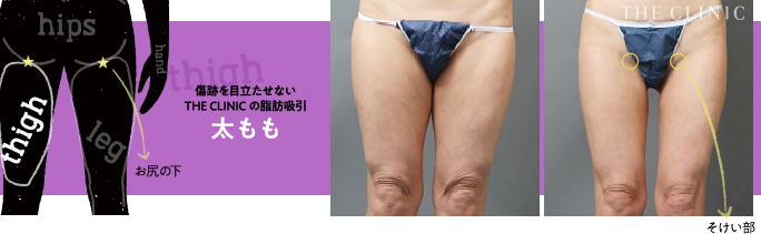 太ももの脂肪吸引の傷跡