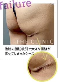 他院の脂肪吸引後、大きな傷跡が残ってしまったケース