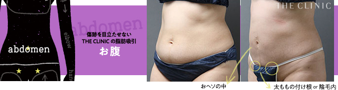お腹の脂肪吸引の傷跡
