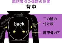 背中の脂肪吸引の傷跡