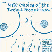 小さいバストになるには? 乳房縮小術と胸の脂肪吸引の違い