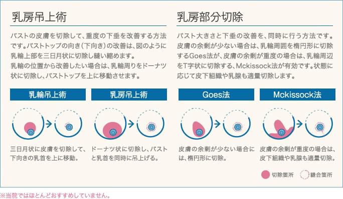 THECLINICの乳房縮小(胸を小さくする切る手術)
