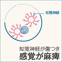 胸を切る乳房縮小術の懸念点①胸の感覚が麻痺することがある