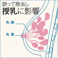 胸を切る乳房縮小術の懸念点②授乳に影響する可能性がある