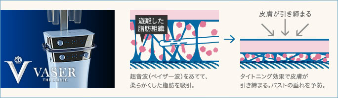 切らずに胸を小さくする手術①ベイザー脂肪吸引