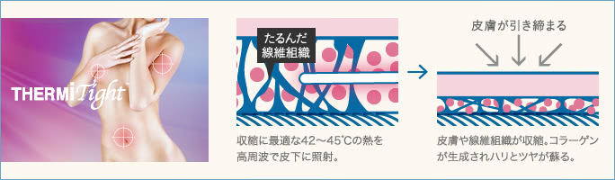 切らずに胸を小さくする手術②サーミタイト