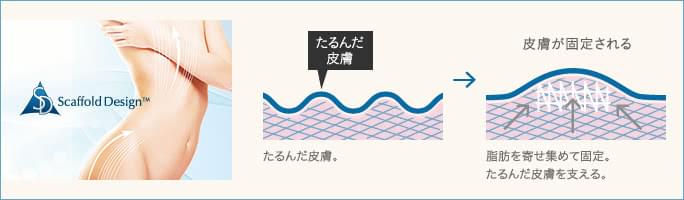 切らずに胸を小さくする手術③ボディリフトSD