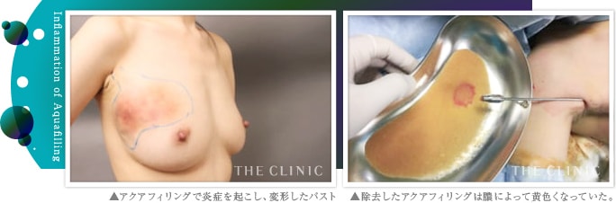 アクアフィリング（アクアリフト）豊胸でよくある失敗:組織に入り込み、炎症