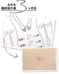 太もも脂肪吸引の傷跡（術後3ヵ月時点）