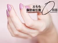 脂肪吸引の手術直後はネイルサロンに行ける程