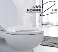 太もも脂肪吸引のダウンタイム中、苦労したこと