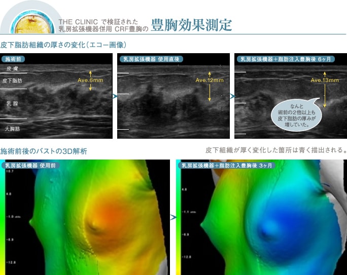 ザクリニック で確認された脂肪注入豊胸の定着状況