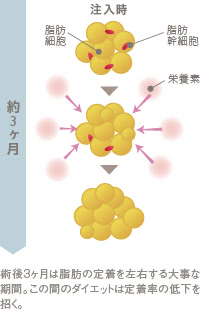 脂肪注入後、脂肪が定着するまでのプロセス