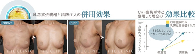 乳房拡張機器と脂肪注入の併用効果