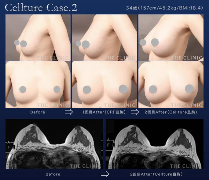 コンデンスセルチャー豊胸（培養幹細胞豊胸）の術前後比較（豊胸回数2回）