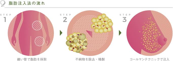脂肪注入の流れ