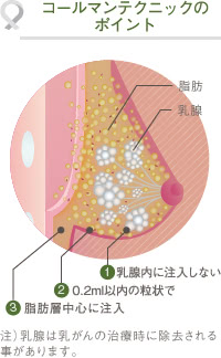 コールマンテクニックのポイント