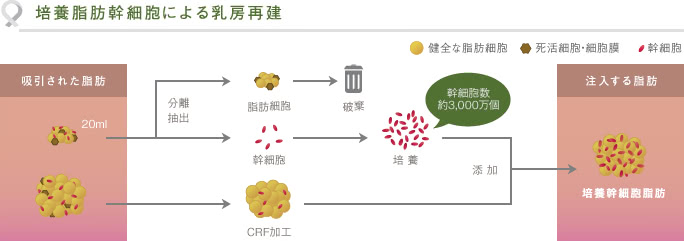 培養脂肪幹細胞による乳房再建
