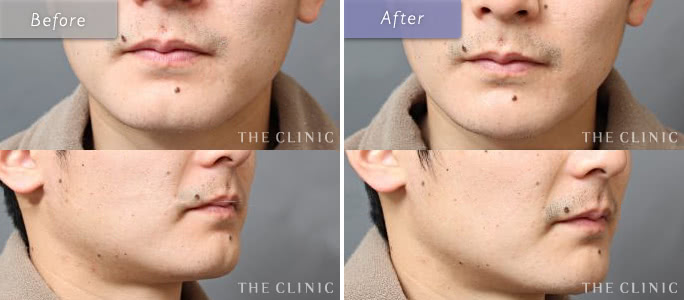 男性の割れ顎整形の効果（術前/術後）