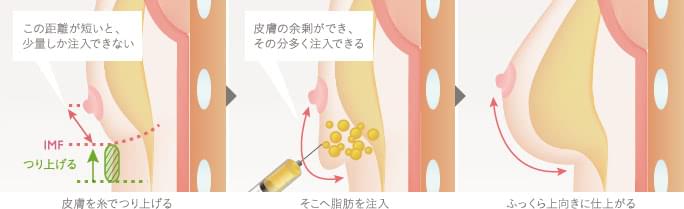 上向きバスト豊胸の仕組み