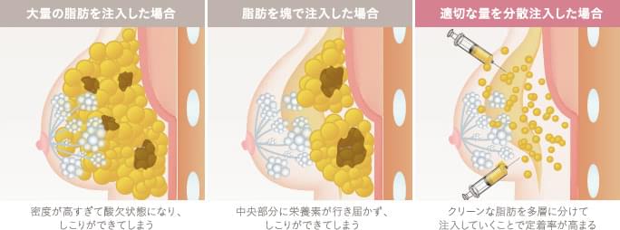 脂肪注入豊胸の量と注入方法