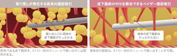 従来の脂肪吸引とベイザー脂肪吸引の比較