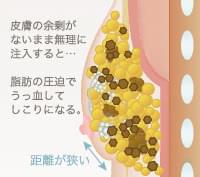 脂肪注入豊胸のしこり