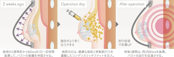 乳房拡張機器・ビブラの仕組み