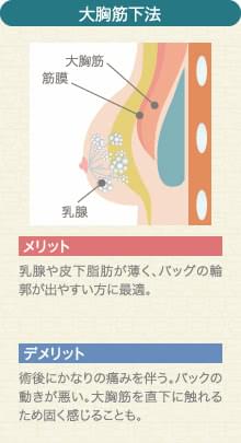 大胸筋下法