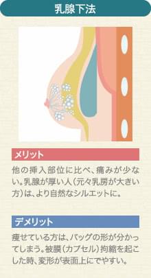 乳腺下法