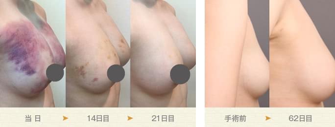 脂肪豊胸のダウンタイム（術後3週間）