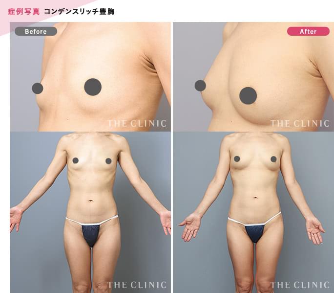 痩せた方への脂肪豊胸の成果（術前・術後）