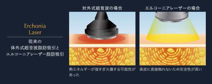 従来の体外式超音波脂肪吸引とエルコー二アレーザー脂肪吸引