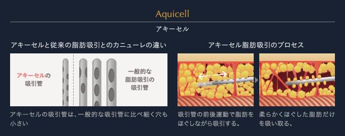 アキーセルと従来の脂肪吸引カニューレとの違い／アキーセル脂肪吸引のプロセス