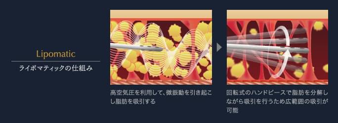 ライボマティックの仕組み