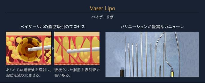 ベイザーリポの脂肪吸引のプロセス／バリエーションが豊富なカニューレ